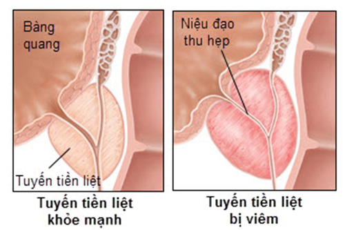 viem-tuyen-tien-liet